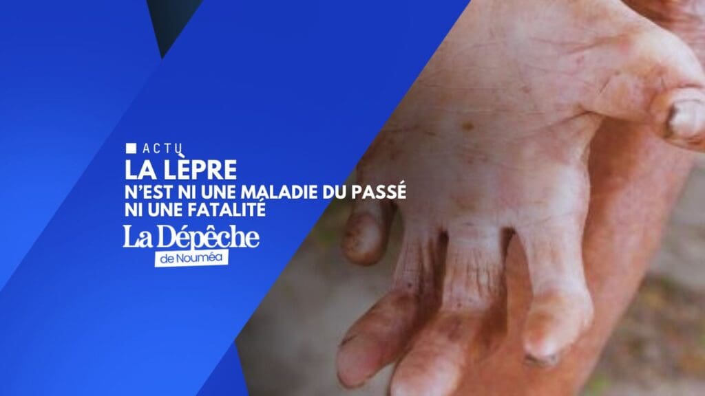 Lèpre : la menace silencieuse que personne ne voit
